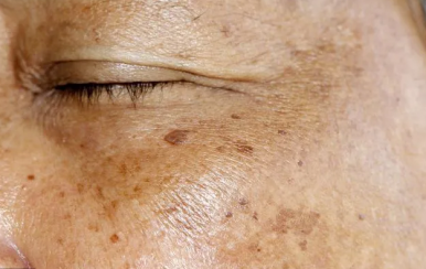 可怕的是老年斑，90后也不放過